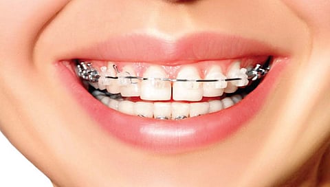 दात पुढे आहेत? आत घेण्यासाठी ‘हा’ आहे सर्वात सोपा उपाय