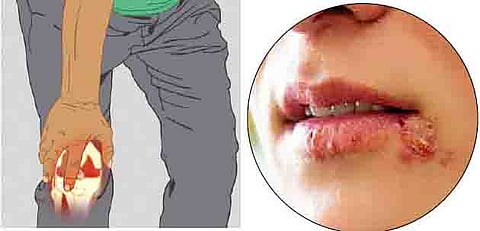 कोविडनंतर रुग्णांना सांधेदुखी, नागीणचा त्रास- त्वचारोगतज्ज्ञ