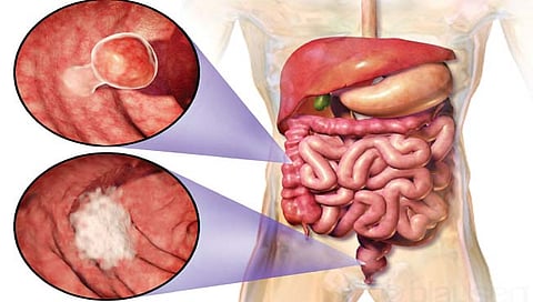 आतड्याचा कर्करोग : दुर्लक्ष नको