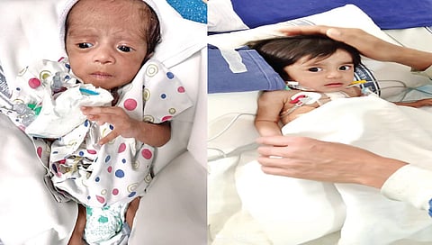 नाशिक : अवघ्या 15 दिवसांच्या नवजात बालकांची यशस्वी हृदयशस्त्रक्रिया