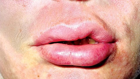 एंजिओएडिमा जाणून घ्या