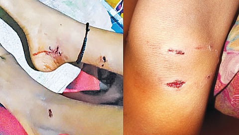 उल्हासनगर : पिसाळलेल्या कुत्र्याने घेतला 16 जणांना चावा