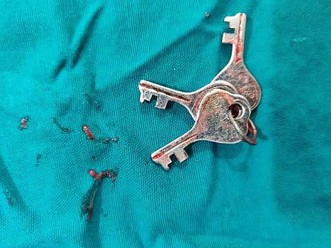 भिगवणच्या बालकाने गिळलेला चाव्यांचा हाच तो चाव्यांचा जुडगा.