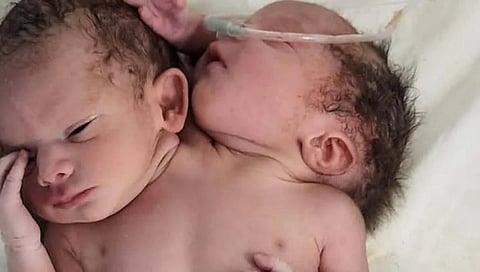 Madhya Pradesh : मध्य प्रदेशातील रतलाममध्ये दोन डोकी, तीन हात असलेल्या बाळाचा जन्म