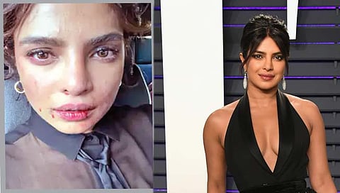 ‘सिटाडेल’ च्या सेटवर प्रियांका चोप्रा ‘जखमी’!