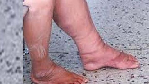 ठाणे : हत्तीरोगाचा फैलाव