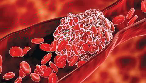 रक्ताची गुठळी होणे म्हणजे काय? त्याची निर्मिती आणि त्यापासून बचाव