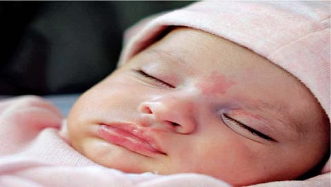 स्कीन : बाळाच्या त्वचेच्या समस्या