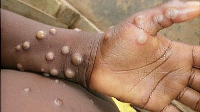 Monkeypox : केरळमध्ये आढळला मंकीपॉक्सचा पहिला रूग्ण