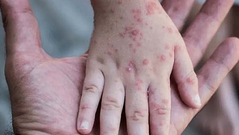 Monkeypox disease | आजारी व्यक्ती, जंगली प्राण्यांशी संपर्क टाळा, मंकीपॉक्स रोखण्यासाठी मार्गदर्शक तत्त्वे जारी
