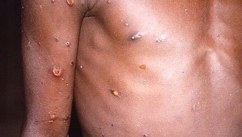 Monkeypox : संकट संपेना! अमेरिकेत सापडला मंकीपॉक्सचा पहिला रुग्ण, जाणून घ्या याची लक्षणे