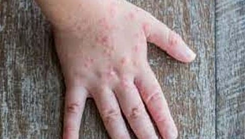 Tomato fever : ‘टोमॅटो फिव्हर’चा केरळमध्ये धोका ; ८० हून अधिक मुलांना लागण