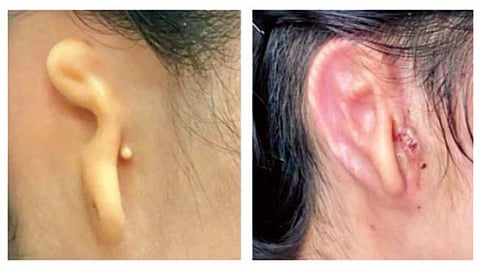 थ्री-डी प्रिंटेड कान!