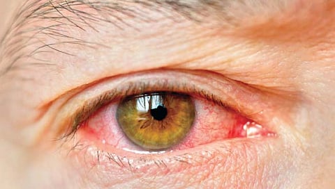 डोळ्यातील कचरा