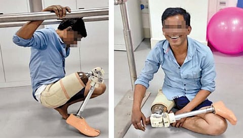 भारतीय जीवनशैलीला अनुकूल कृत्रिम पाय विकसित