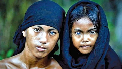 डोळे निळे होण्याचा विचित्र आजार!