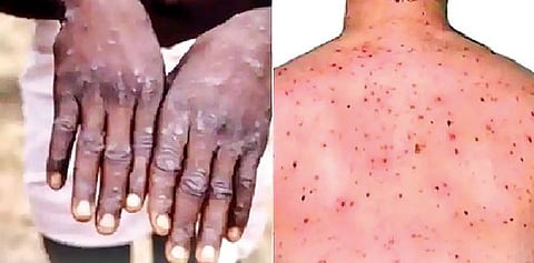 monkeypox : ‘मंकीपॉक्स’ची नको भीती; अशी घ्या काळजी!