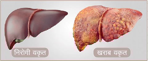 काविळीचा परिणाम थेट यकृतावर; ‘फॅटी लिव्हर’ची समस्या उद्भवणार्यांचे प्रमाण वाढले