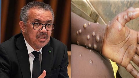 monkeypox : मंकीपॉक्स ही जागतिक आरोग्य आणीबाणी, WHO ची मोठी घोषणा