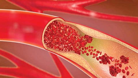 blood vessel: रक्तवाहिन्यांत चरबी जमा झाल्यास…