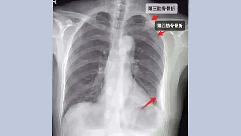 ‘जादूची’ नव्हे, ‘हड्डी तोड झप्पी’!