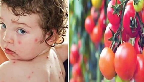 तीन राज्यांत लहान मुलांवर टोमॅटो फ्लू आजाराचे संकट!
