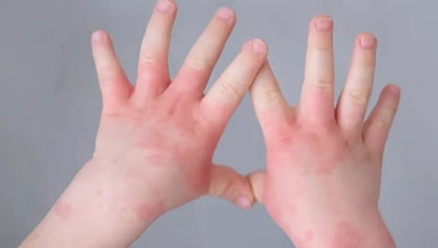 Tomato Flu : टोमॅटो फ्ल्यूची दहशत: केंद्राच्या राज्यांना मार्गदर्शक सूचना