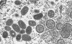 जगातील पहिलीच केस: एका व्यक्तीला कोरोना, मंकीपॉक्स आणि एचआयव्हीची एकत्र लागण; कारण, अनेक पुरुषांसोबत असुरक्षित लैंगिक संबंध