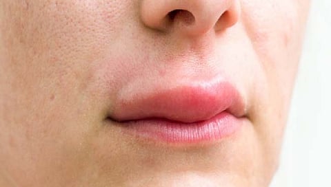 चेहर्याला सूज आल्यास...