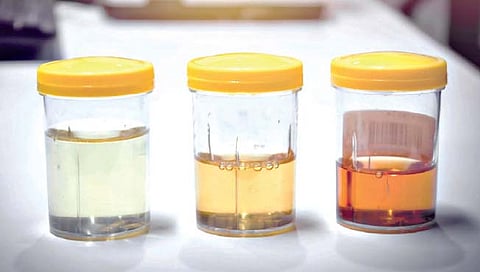 ‘या’ कारणांनी लघवीचा रंग बदलतो, जाणून घ्या लक्षणे आणि उपचार