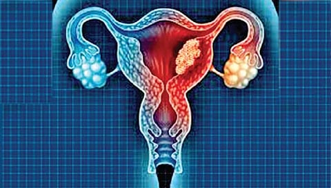 गर्भाशयाला कॅन्सरचा धोका; वेळेत निदान केल्यास मात शक्य