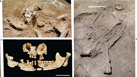 31 हजार वर्षांपूर्वी शस्त्रक्रिया करून काढला होता पाय!
