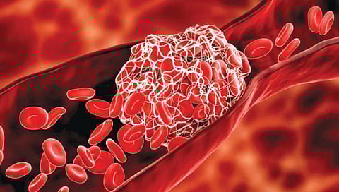 ब्लड क्लॉटिंग म्हणजे काय? जाणून घ्या माहिती