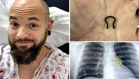 नाकातली रिंग सापडली फुफ्फुसात!