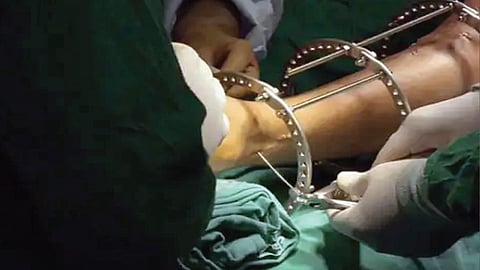 अमेरिकेतील पुरुषांमध्ये उंची वाढवणार्या शस्त्रक्रियेची ‘क्रेझ’