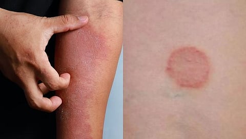 Life Style : खाज सुटणे, जळजळणे, असे त्वचाविकार वारंवार होतात का? ‘हे’ कारण असू शकते