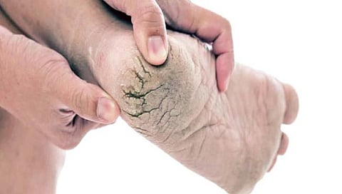 टाचेला का पडतात भेगा?