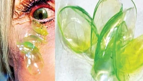 महिलेच्या डोळ्यातून काढल्या 23 कॉन्टॅक्ट लेन्सेस