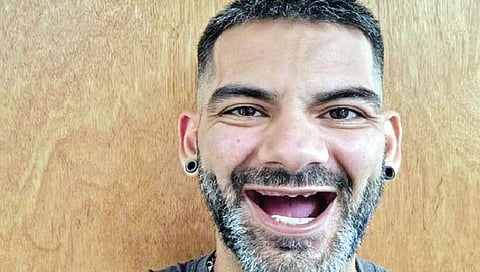 29 व्या वर्षांपूर्वीच पडले दात; आता 36 लाखांचा खर्च