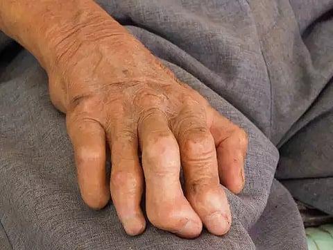 पुणे : कुष्ठरोग प्रसाराचा दर राज्यात देशापेक्षा दुप्पट