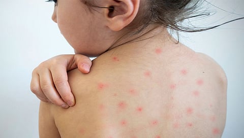 कुदळवाडीत गोवर संशयित रुग्ण पालिकेकडून शोधमोहीम