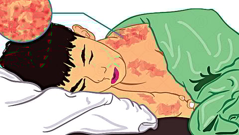 Measles Disease : कोरोना महामारीमुळेच गोवरचा विस्फोट, काय सांगताय तज्ज्ञ?