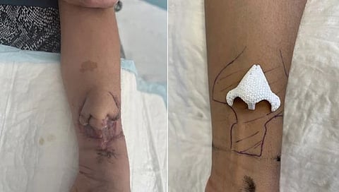 Nasal Cavity Cancer :