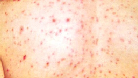 गोवर भारतात पुन्हा का परततोय?