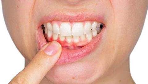 पायरियाचा आजार आणि दातांचे आरोग्य, अशी घ्या काळजी…