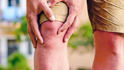 पुणे : हिवाळ्यात नव्याने उद्भवतोय संधिवात