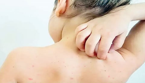 पुणे : घरीच प्रसूती होणार्या जिल्ह्यांत गोवरच्या उद्रेकाची शक्यता