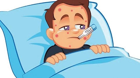 पुणे : राज्यांत 4 वर्षांत 941 जणांना गोवरची लागण