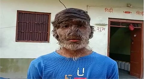 कुणी म्हणते बाल हनुमान, तर कुणी मारते दगड : दुर्मिळ आजारामुळे युवकाच्या सर्वांगावर केस (Werewolf Syndrome)