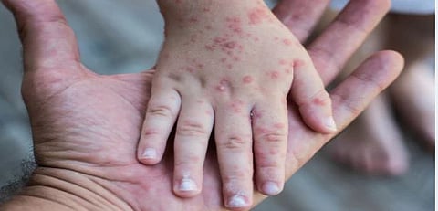 पिंपरी : सावधान ! पुन्हा गोवर डोकेवर काढतोय ; महिनाभरात वाढले 22 रुग्ण